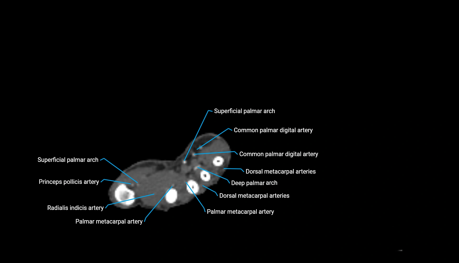 CTA upper limb axial cross sectional anatomy labelled image 61 (2).webp